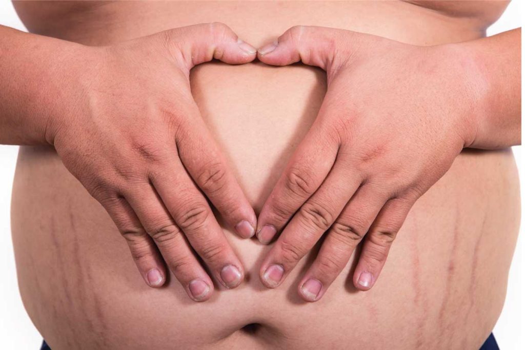 استریا- ترکهای چاقی روی پوست- کلینیک زروان