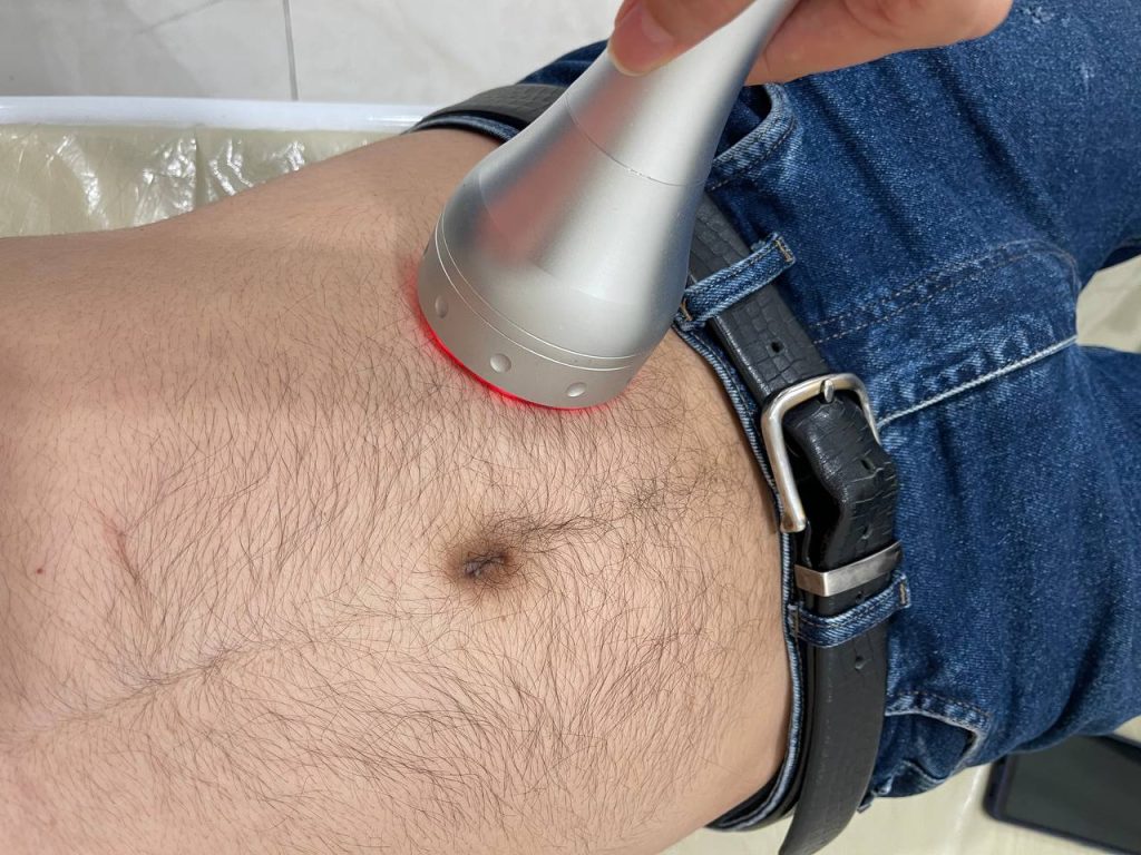 آراف وکیوم لاغری موضعی کلینیک زروان، دستگاه آراف لاغری، لاغری با RF، آراف شکم و پهلو، رادیوفرکانسی لاغری، RF body contouring، لاغری موضعی بدون جراحی، سفت شدن پوست با آراف، لاغری با دستگاه آراف