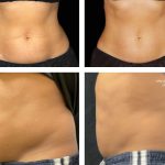 بهترین دستگاه لاغری | مقایسه روش‌های لاغری تهاجمی و غیرتهاجمی