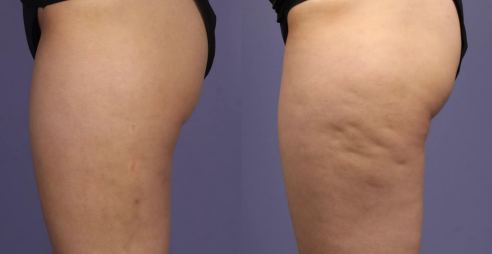 درمان سلولیت، سلولیت، سلولیت باسن، سلولیت پا، پوست ناصاف، کلینیک زروان ، کلینیک زروان غرب تهران، ستارخان 66921615