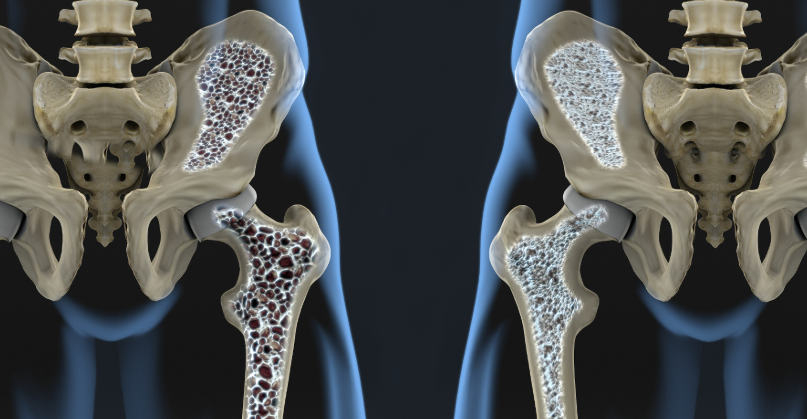 کنترل و درمان پوکی استخوان، کلینیک تقویت عضلات ، پیشگیری از پوکی استخوان با ام اسکالپت، ورزش برای درمان اُستئوپروز،تقویت عضلات بدون فشار بر مفاصل ،افزایش تراکم استخوانی با ای ام اسکالپت، زروان ، تهران، غرب تهران، ستارخان، 66921615