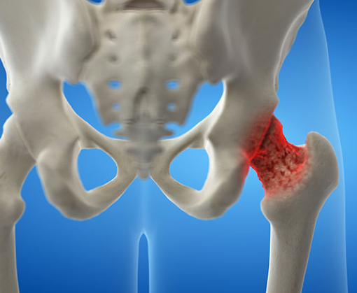 کنترل و درمان پوکی استخوان، کلینیک تقویت عضلات ، پیشگیری از پوکی استخوان با ام اسکالپت، ورزش برای درمان اُستئوپروز،تقویت عضلات بدون فشار بر مفاصل ،افزایش تراکم استخوانی با ای ام اسکالپت، زروان ، تهران، غرب تهران، ستارخان، 66921615