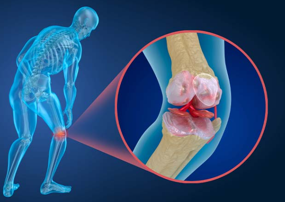کنترل و درمان پوکی استخوان، کلینیک تقویت عضلات ، پیشگیری از پوکی استخوان با ام اسکالپت، ورزش برای درمان اُستئوپروز،تقویت عضلات بدون فشار بر مفاصل ،افزایش تراکم استخوانی با ای ام اسکالپت، زروان ، تهران، غرب تهران، ستارخان، 66921615