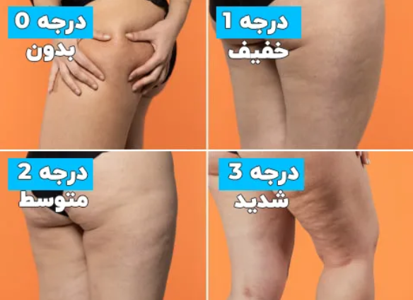 درمان سلولیت، سلولیت، سلولیت باسن، سلولیت پا، پوست ناصاف، کلینیک زروان ، کلینیک زروان غرب تهران، ستارخان 66921615