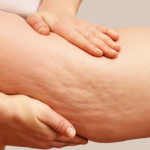 رفع سلولیت ران و باسن بدون جراحی با تکنولوژی آر اف و وکیوم