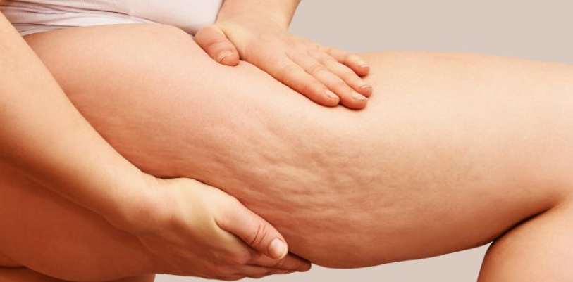 درمان سلولیت، سلولیت، سلولیت باسن، سلولیت پا، پوست ناصاف، کلینیک زروان ، کلینیک زروان غرب تهران، ستارخان 66921615