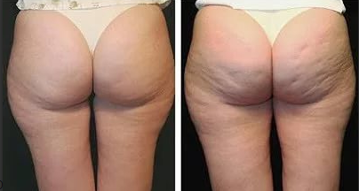 درمان سلولیت، سلولیت، سلولیت باسن، سلولیت پا، پوست ناصاف، کلینیک زروان ، کلینیک زروان غرب تهران، ستارخان 66921615