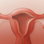 تنبلی تخمدان (PCOS) و چاقی: علائم، درمان و راهکارهای کاهش وزن در زنان