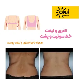 لاغری موضعی، لاغری شکم پهلو، لاغری باسن، کویتیشن ،آراف لاغری، EMS، فرمدهی لاغری، مرکز لاغری زروان، ستارخان 66921615،