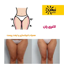 لاغری موضعی، لاغری ران،لاغری پا، لاغری شکم پهلو، لاغری باسن، کویتیشن ،آراف لاغری، EMS، فرمدهی لاغری، مرکز لاغری زروان، ستارخان 66921615،