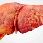 کمبود امگا ۳؛ دلیل پنهان بدتر شدن کبد چرب که خیلی‌ها خبر ندارند!