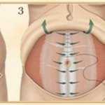 قبل از عمل جراحی لاغری شکم چه کنیم؟ لاغری با دستگاه و راهکارهای بدون جراحی