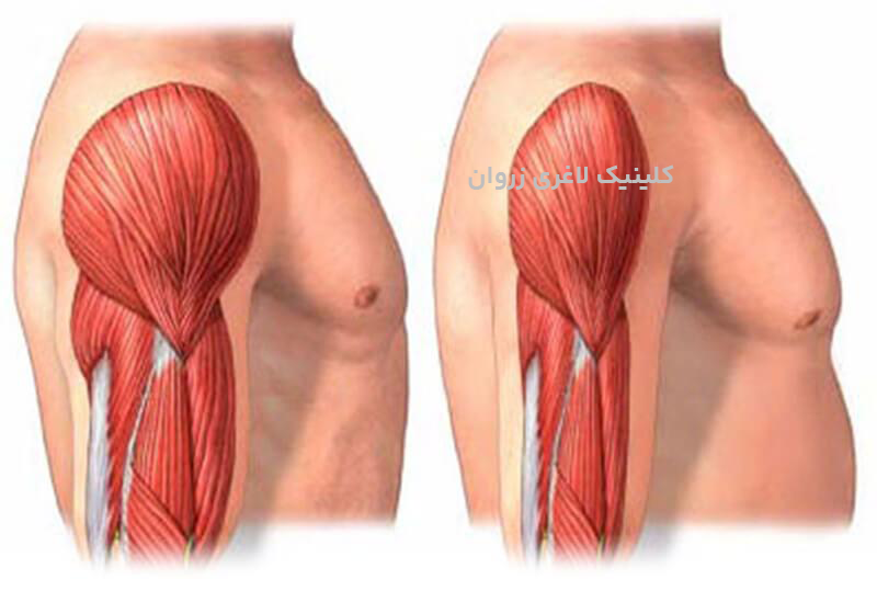 حفظ عضله در رژیم، سارکوپنی چیست، چرا وزن کم نمی‌کنم، استپ وزنی، علت عدم کاهش وزن، ثابت ماندن وزن در رژیم، کند شدن متابولیسم بدن، کاهش متابولیسم بعد از رژیم، بازگشت وزن بعد از رژیم، یویو افکت،