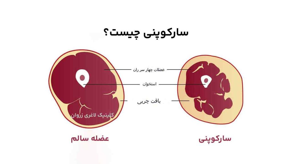 حفظ عضله در رژیم، سارکوپنی چیست، چرا وزن کم نمی‌کنم، استپ وزنی، علت عدم کاهش وزن، ثابت ماندن وزن در رژیم، کند شدن متابولیسم بدن، کاهش متابولیسم بعد از رژیم، بازگشت وزن بعد از رژیم، یویو افکت،