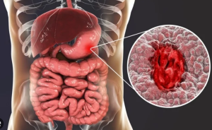 برنامه غذایی زخم معده و لاغری،برای زخم معده چی بخوریم،رژیم غذایی زخم معده،رژیم لاغری مناسب زخم معده،لاغری با زخم معده،برای زخم معده و لاغری چی بخوریم،برنامه کاهش وزن بدون سوزش معده