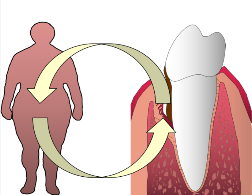 علت خراب شدن دندان در افراد چاق، چاقی و خونریزی لثه،چرا دندان‌ها با چاقی خراب می‌شوند، رابطه التهاب لثه و چاقی، ارتباط اضافه وزن و تحلیل استخوان دندان