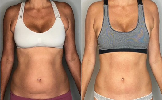 آراف بعد از لیپو، کویتیشن شکم، درمان غیرجراحی ناصافی شکم، صاف شدن پوست شکم بعد از لیپوساکشن، رفع موج‌دار شدن شکم، نرم کردن فیبروز، یکنواخت کردن کانتور شکم، رفع برجستگی و فرورفتگی بعد از لیپو