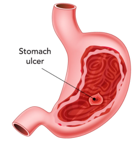 برنامه غذایی زخم معده و لاغری،برای زخم معده چی بخوریم،رژیم غذایی زخم معده،رژیم لاغری مناسب زخم معده،لاغری با زخم معده،برای زخم معده و لاغری چی بخوریم،برنامه کاهش وزن بدون سوزش معده