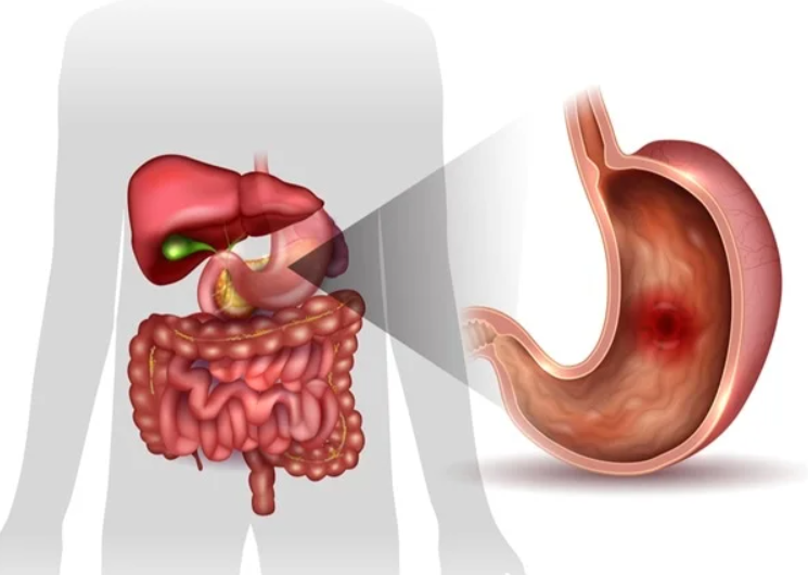 برنامه غذایی زخم معده و لاغری،برای زخم معده چی بخوریم،رژیم غذایی زخم معده،رژیم لاغری مناسب زخم معده،لاغری با زخم معده،برای زخم معده و لاغری چی بخوریم،برنامه کاهش وزن بدون سوزش معده