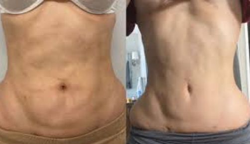 آراف بعد از لیپو، کویتیشن شکم، درمان غیرجراحی ناصافی شکم، صاف شدن پوست شکم بعد از لیپوساکشن، رفع موج‌دار شدن شکم، نرم کردن فیبروز، یکنواخت کردن کانتور شکم، رفع برجستگی و فرورفتگی بعد از لیپو