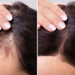 کربوکسیتراپی مو چیست و مناسب چه کسانی است؟ تفاوت کربوکسیتراپی کلینیکی با کربوکسیتراپی آرایشگاهی