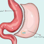 عوارض درازمدت اسلیو معده؛ هر آنچه باید قبل و بعد از عمل بدانید