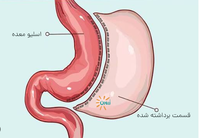 عوارض اسلیو معده،مشکلات بعد از اسلیو معده، عوارض دیررس اسلیو، رفلاکس بعد از اسلیو، کمبود ویتامین بعد از اسلیو، کاهش وزن بدون جراحی، عمل اسلیو معده،ریزش مو بعد از اسلیو، هزینه اسلیو معده