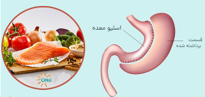 عوارض اسلیو معده،مشکلات بعد از اسلیو معده، عوارض دیررس اسلیو، رفلاکس بعد از اسلیو، کمبود ویتامین بعد از اسلیو، کاهش وزن بدون جراحی، عمل اسلیو معده،ریزش مو بعد از اسلیو، هزینه اسلیو معده
